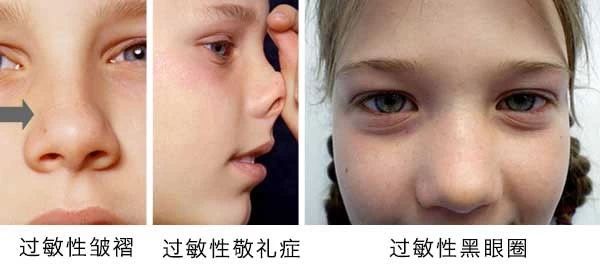 過(guò)敏性鼻炎會(huì)讓孩子變傻？！家長(zhǎng)該如何應(yīng)對(duì)
